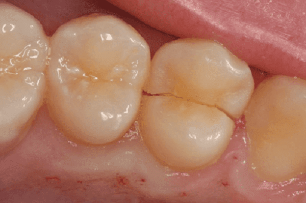شکستن دندان پس از عصب کشی