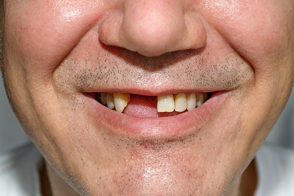 تاثیر افتادن دندان در سنین بالا