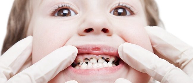 اثر ژنتیک بر دندان کودک