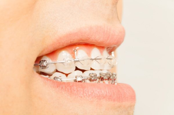 درمان دندان های نامرتب