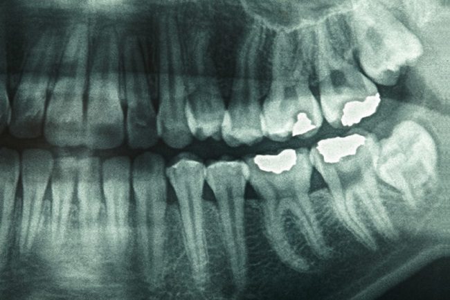 عکس برداری از دندان با اشعه ایکس